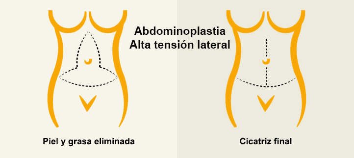 Abdominoplastia de alta tensión lateral o flor de lis