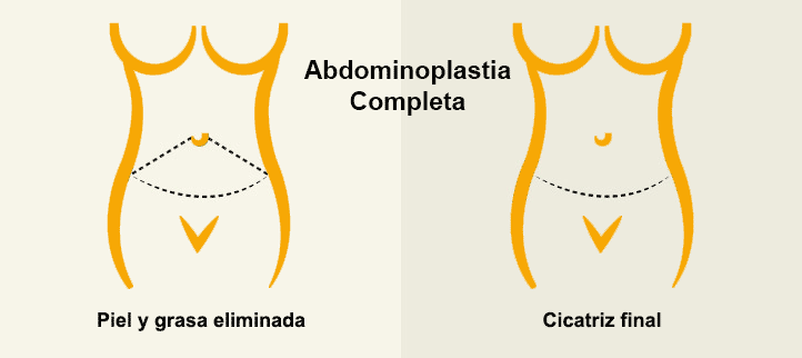 Abdominoplastia o lipoescultura del abdomen completa