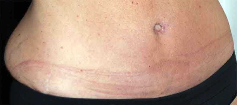 Abdominoplastia láser