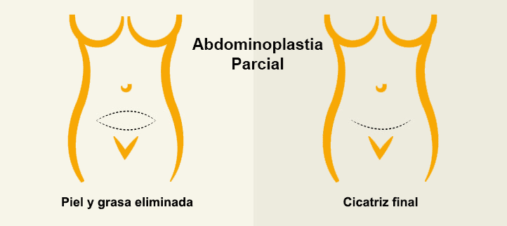 Abdominoplastia parcial o Minidermolipectomía
