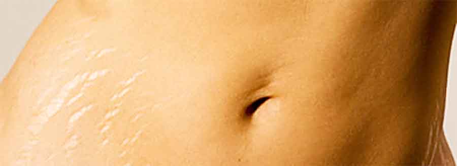 Abdominoplastia estrías